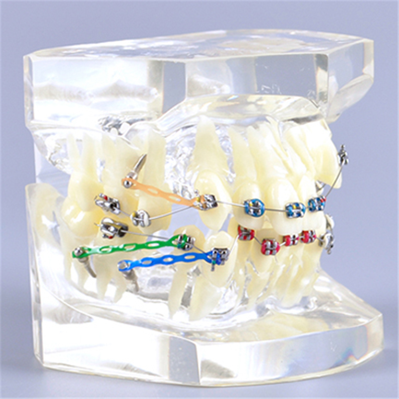 dental typodont teeth model demonstrate orthodontic treatment dental study model with bracket and ligature wire