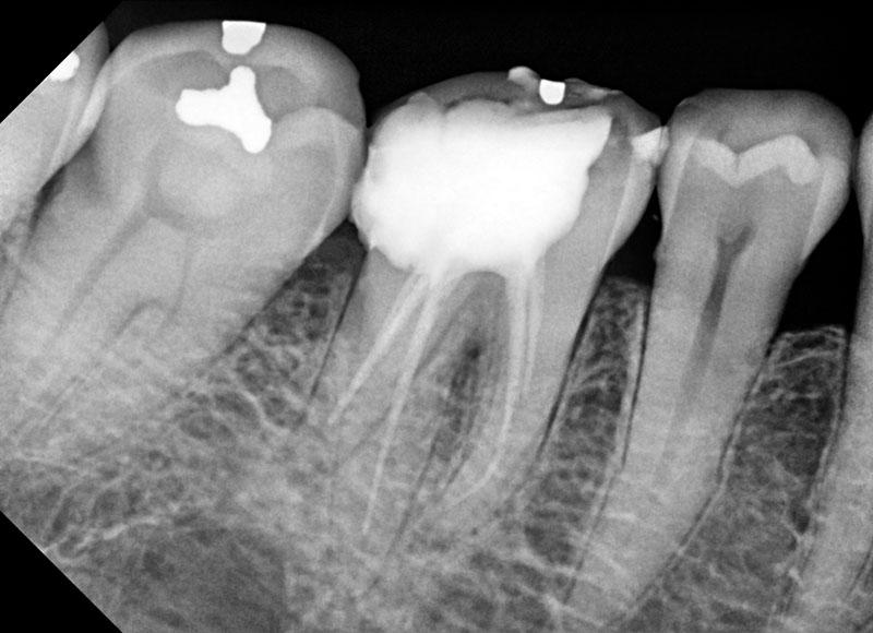High Quality ATECO Dental Digital Intraoral Imaging Dental x-ray sensor ateco wireless