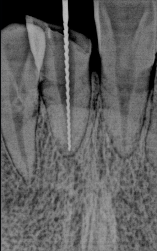 Dental intraoral digital x ray EZ sensor Vatech authentic sensor size 1.5 digital x-ray sensor