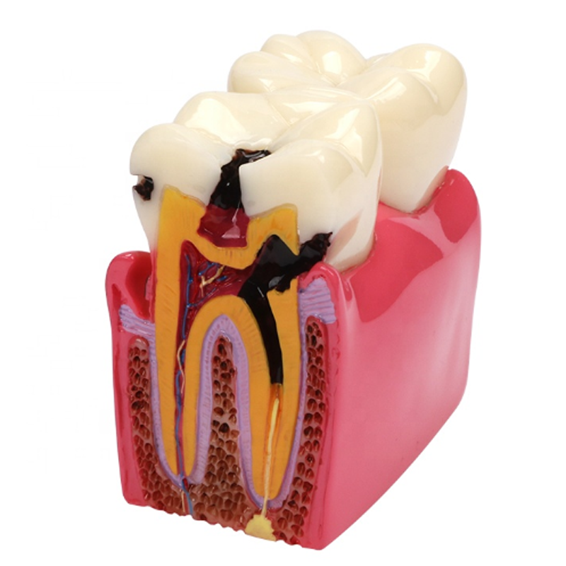 high quality dental orthodontic pathology dental model demonstration tooth caries model study teeth model