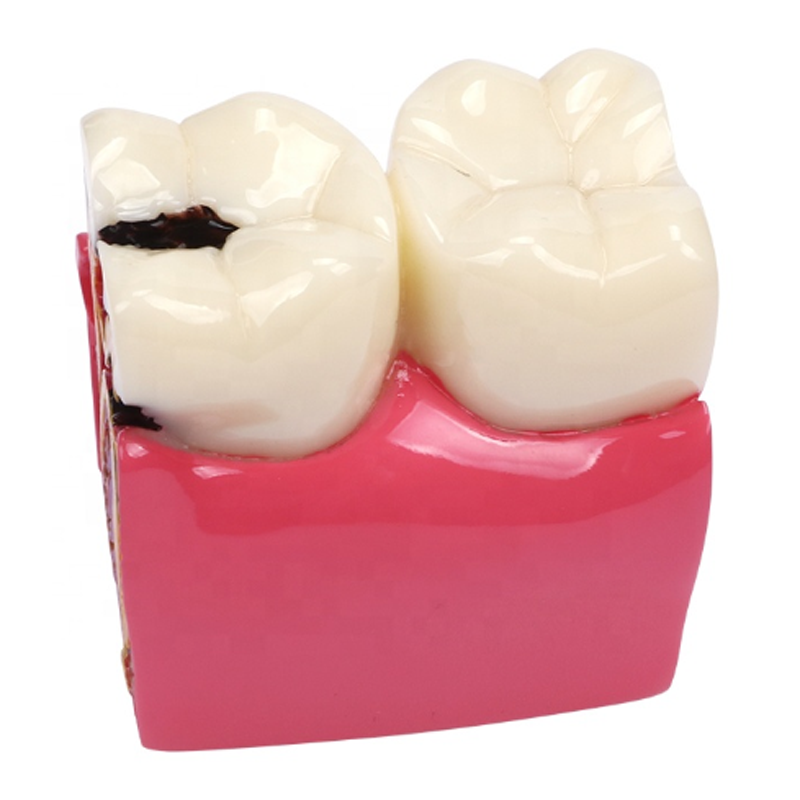 dental training caries model compares the healthy and caries tooth orthodontic dental practice teaching model