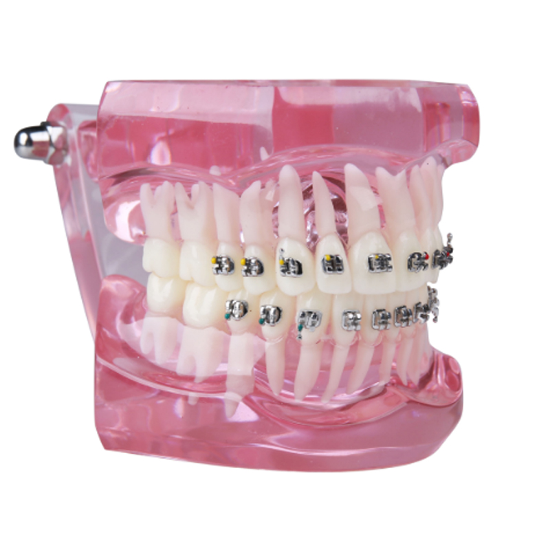 dental metal bracket teeth model orthodontic dental teaching model brackets standard clear model