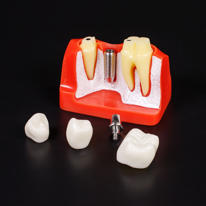 4 times dental single implant analysis model M2017R explain the single implant and bridge dental training model