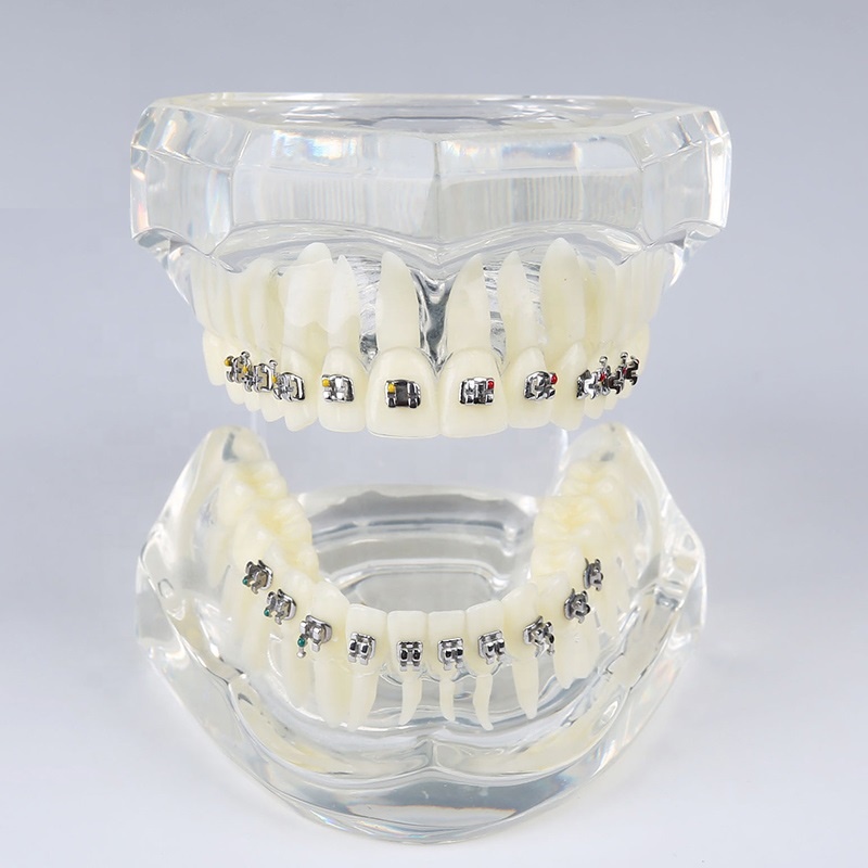 Massive Selection for Trimmer Dental Lab - dental demonstration orthodontic model dental practice typodont with all metal bracket dental standard model removable teeth – Onice