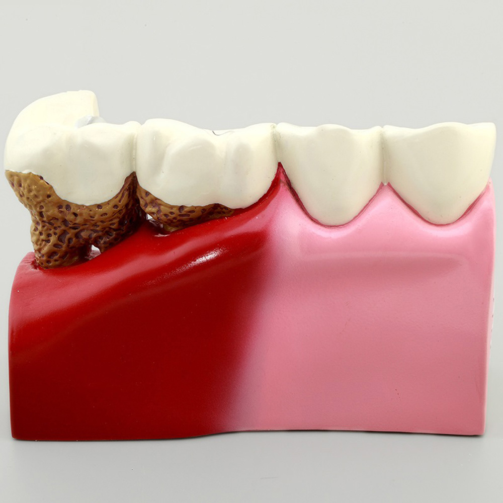 human four times caries periodontal pathology model removable teeth implant model dental typodont anatomical model