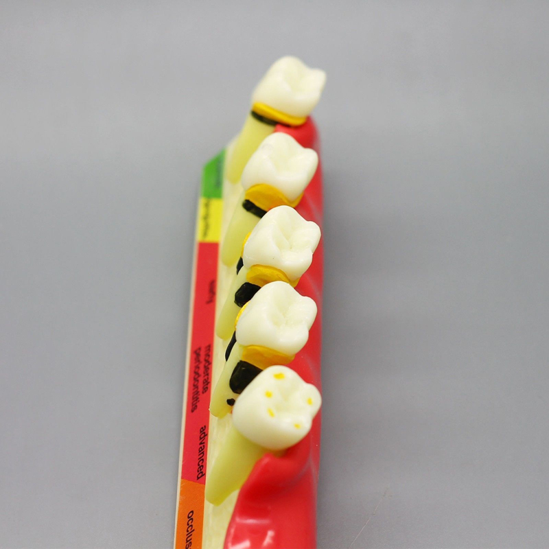 dental pathological periodontal disease model orthodontic medical instrument dental teaching teeth model