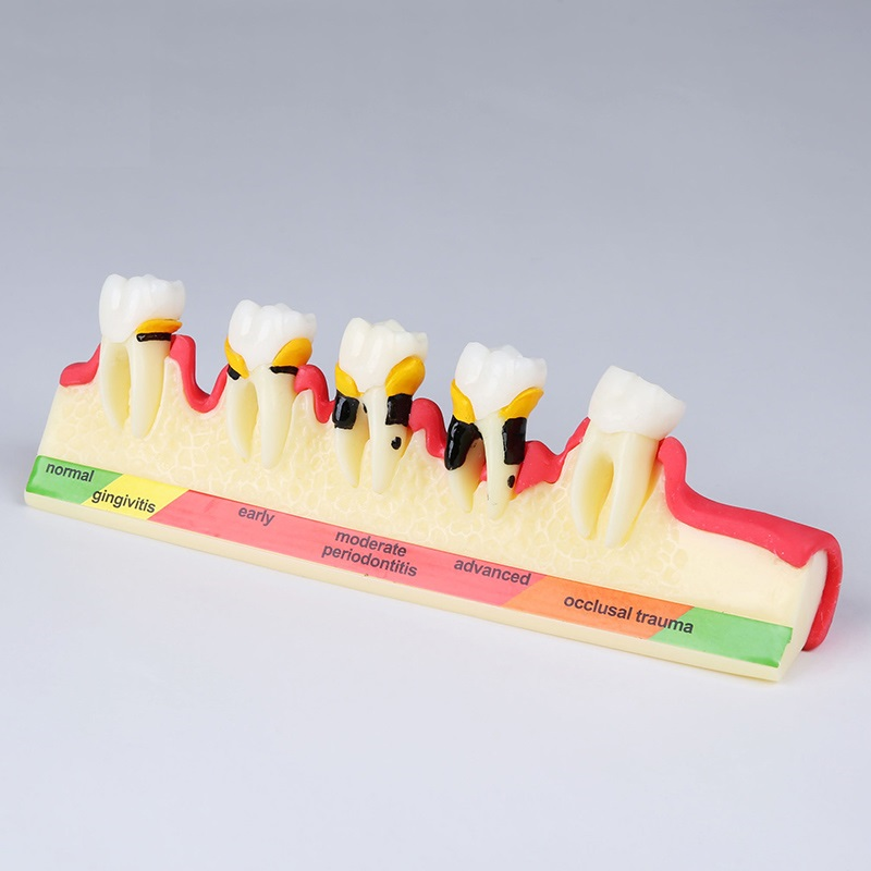 dental pathological periodontal disease model orthodontic medical instrument dental teaching teeth model