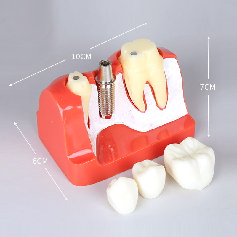 single implant demonstration model of dental implant analysis teaching and study orthodontic dental resin model