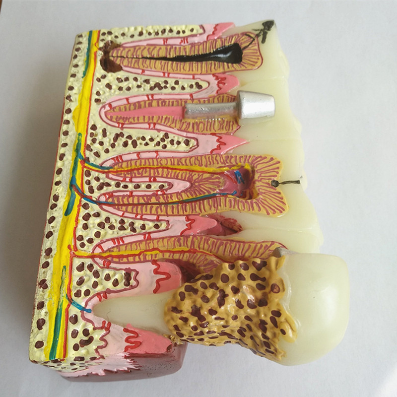 dental pathologies model human 4 times caries periodontal root canal treatment demonstration model dental typodont adult model