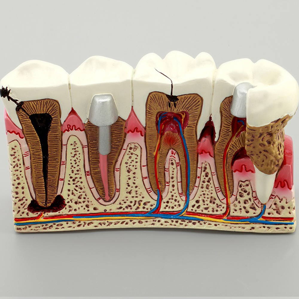 dental pathologies model human 4 times caries periodontal root canal treatment demonstration model dental typodont adult model