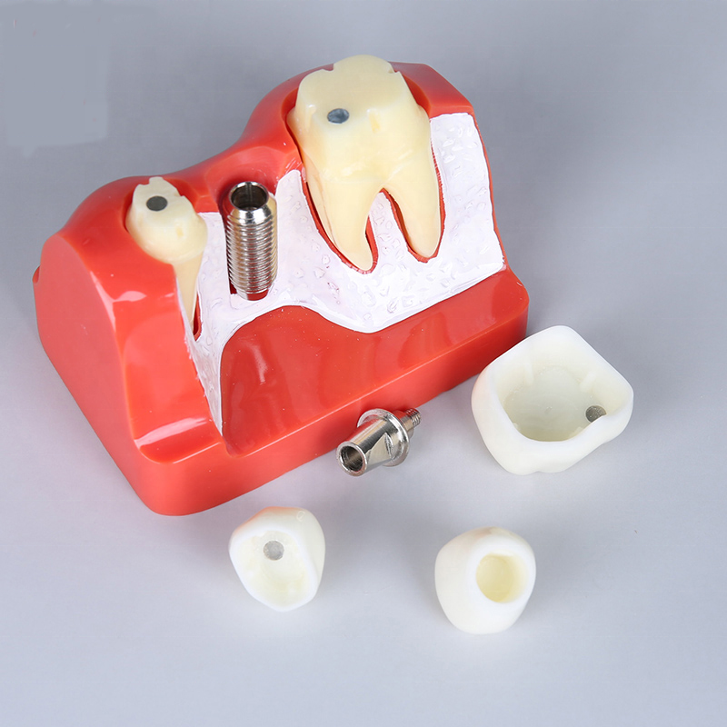 Manufacturer of Dental Flexible Denture Machine - high quality medical dental implant science soft gum teeth model dental implant analysis tooth model dental instrument product – Onice