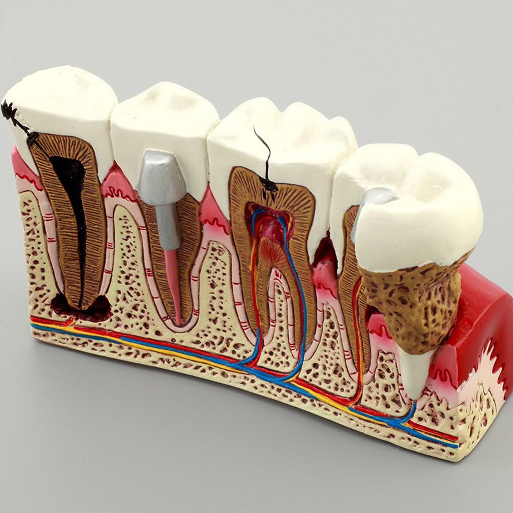 human four times caries periodontal pathology model removable teeth implant model dental typodont anatomical model
