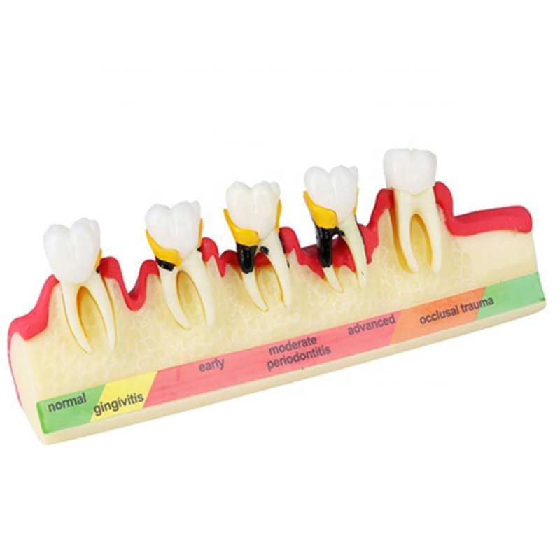 Factory Free sample Common Dental Instruments - dental pathological periodontal disease model orthodontic medical instrument dental teaching teeth model – Onice